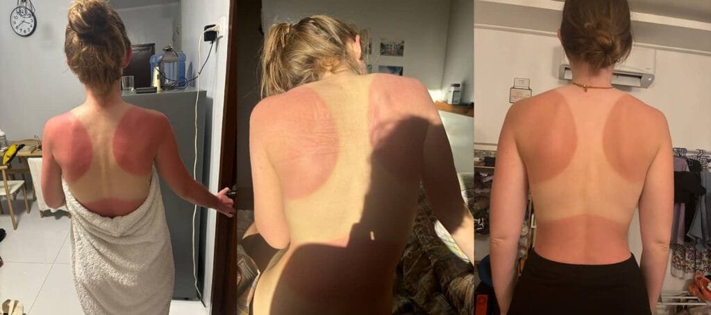 3 photos of the sunburn i got in siargao